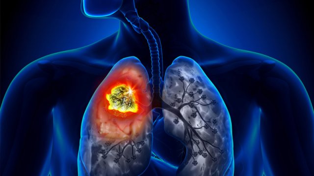 Ağciyər xərçənginin bir növü digərinə çevrilə bilirmiş - Yeni araşdırma