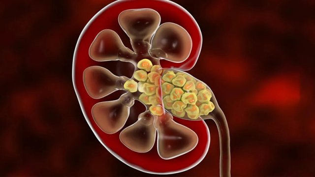 Həkimlər böyrək xərçənginin əlamətlərini açıqladı