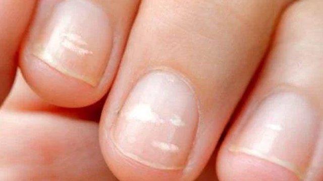 Dırnaqlarımız hansı xəstəliklərdən xəbər verir?
