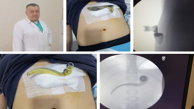 Bakıda ŞOK HADİSƏ - Uşağın qarnından görün nə çıxdı?
