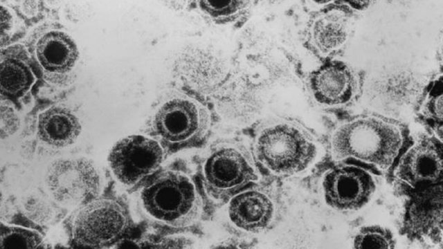 Alimlər izah olunmayan herpes epidemiyasının səbəbini açıqladı