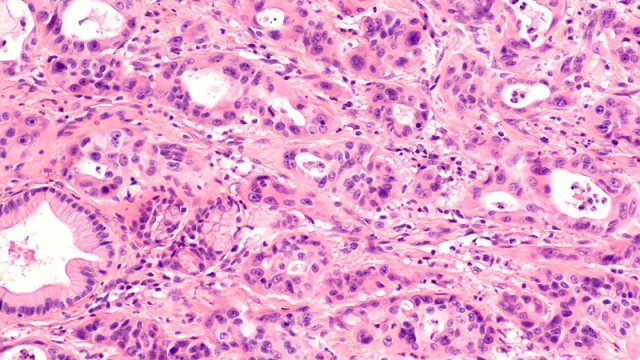 Pankreas xərçənginin yüksək aqressivliyinin səbəbi müəyyən edildi