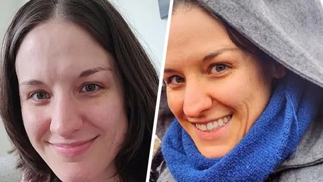 Gündə 5 yerkökü yeyən qadının dərisi narıncı rəngə çevirildi