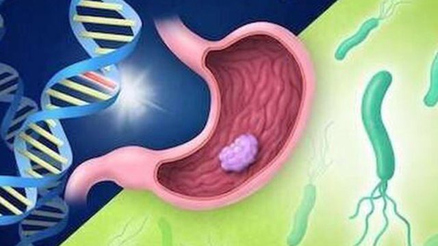 Mədə xərçənginin inkişafının əsas səbəbi açıqlandı