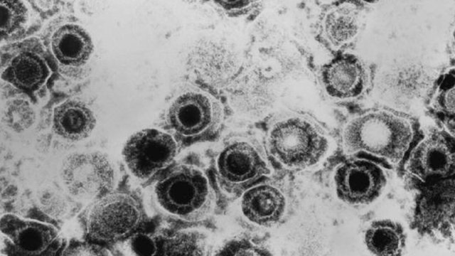 Alimlər herpes virusu ilə dəri xərçənginə qalib gəldi