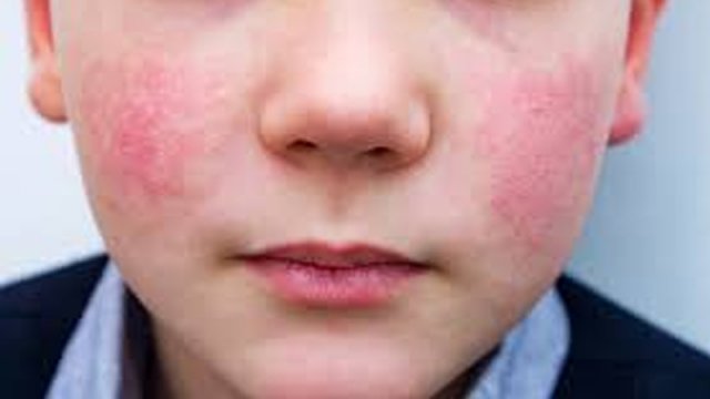 Uşaqlar arasında yeni virus yayıldı: Nələrə diqqət edək?