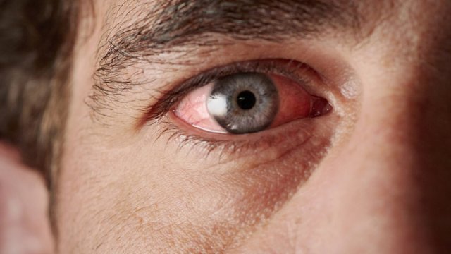 Sağlamlıq problemlərini gözlərlə necə bilmək olar? - Həkim