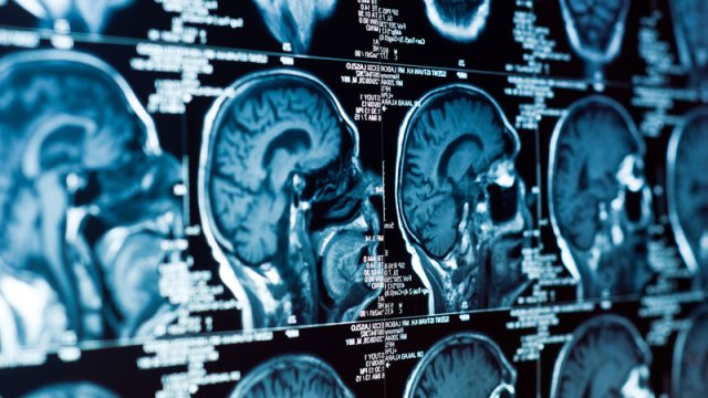 Alimlər beyin xərçənginin müalicəsində əsas problemlərdən birini aradan qaldırdı