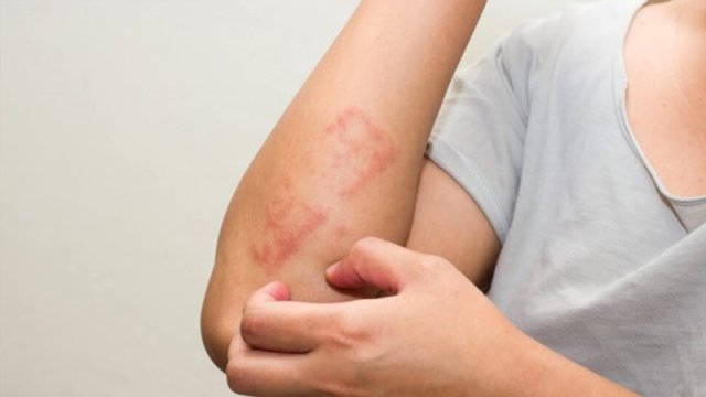 Qida allergiyası nədir?