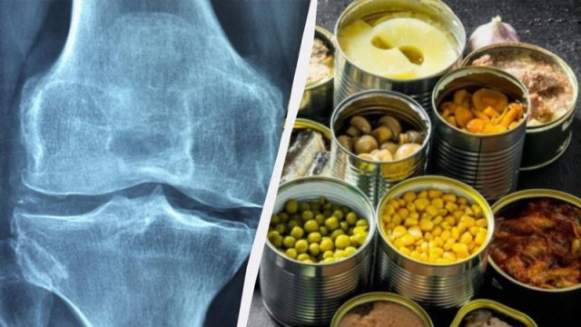 Həkim 50 yaşdan sonra sümükləri möhkəm saxlamağa kömək edən ən yaxşı qidanı açıqladı